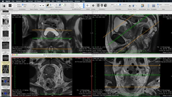 Screenshot OsiriX MD